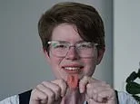 Doctor, 30, receives UK's first prosthetic tongue following cancer treatment: 'People can understand me again'