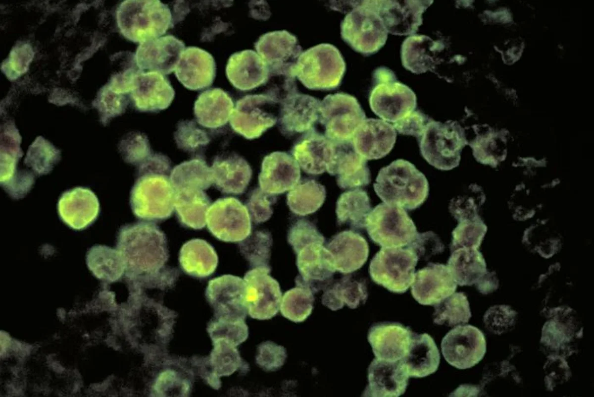 North Carolina teen critically ill after being infected ​with rare brain-eating amoeba