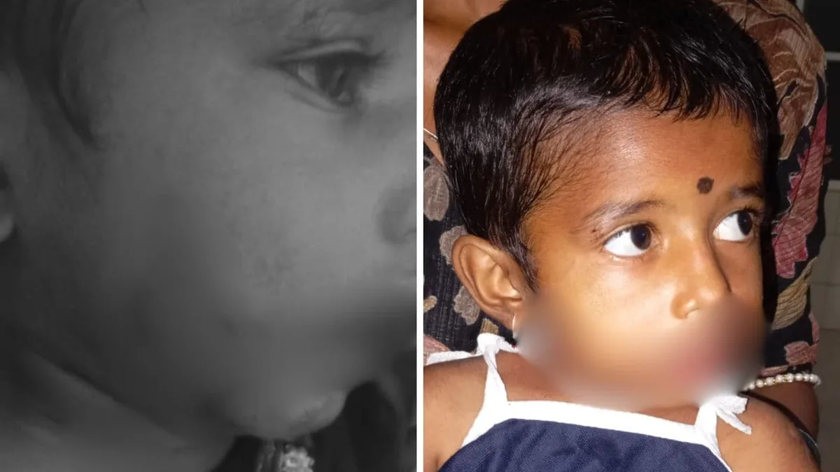 4-Year-Old Girl Attacked By Stray Dogs While Playing At Home In Karnataka