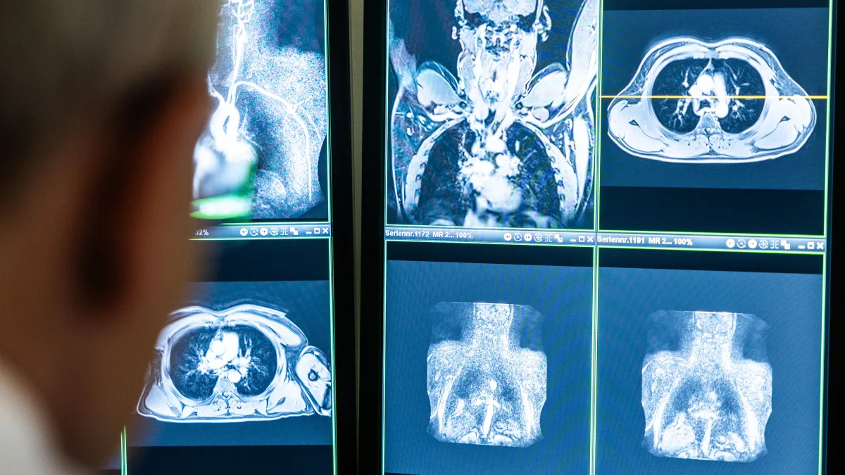 Symptome, Prognose, Therapie: Was man über Lungenkrebs wissen muss