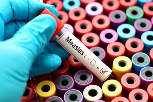 SA measles cases hit 3 462 as unvaccinated infants triple