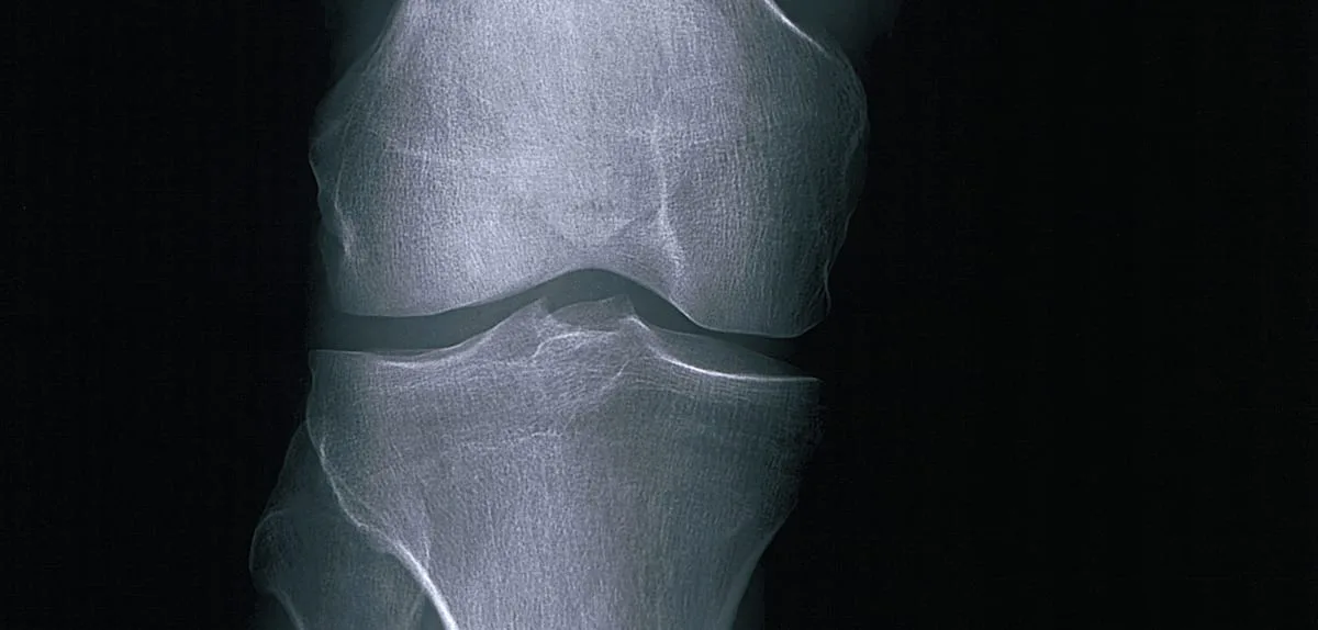 Risiko für Osteoporose – „Ab einem Alter von etwa 30 Jahren geht es los“