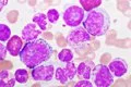 Leucemia mieloide aguda: un tratamiento menos intensivo duplica el tiempo hasta el fracaso frente a la quimioterapia
