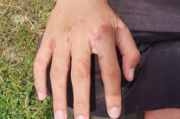 Hospital wards forced to close after Victorian disease scabies outbreak spreads across country