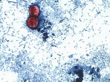 US officials tie cyclospora outbreak involving iceberg lettuce to 3 more states