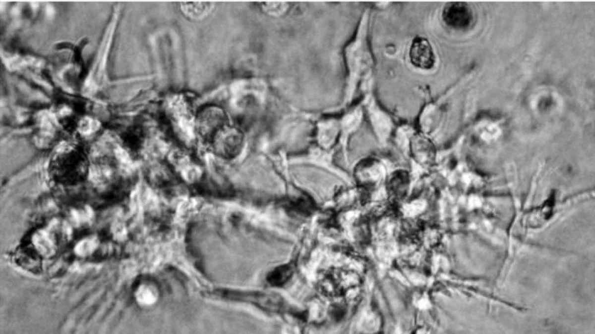 Moderna y Merck anuncian resultados positivos ede su vacuna contra el melanoma