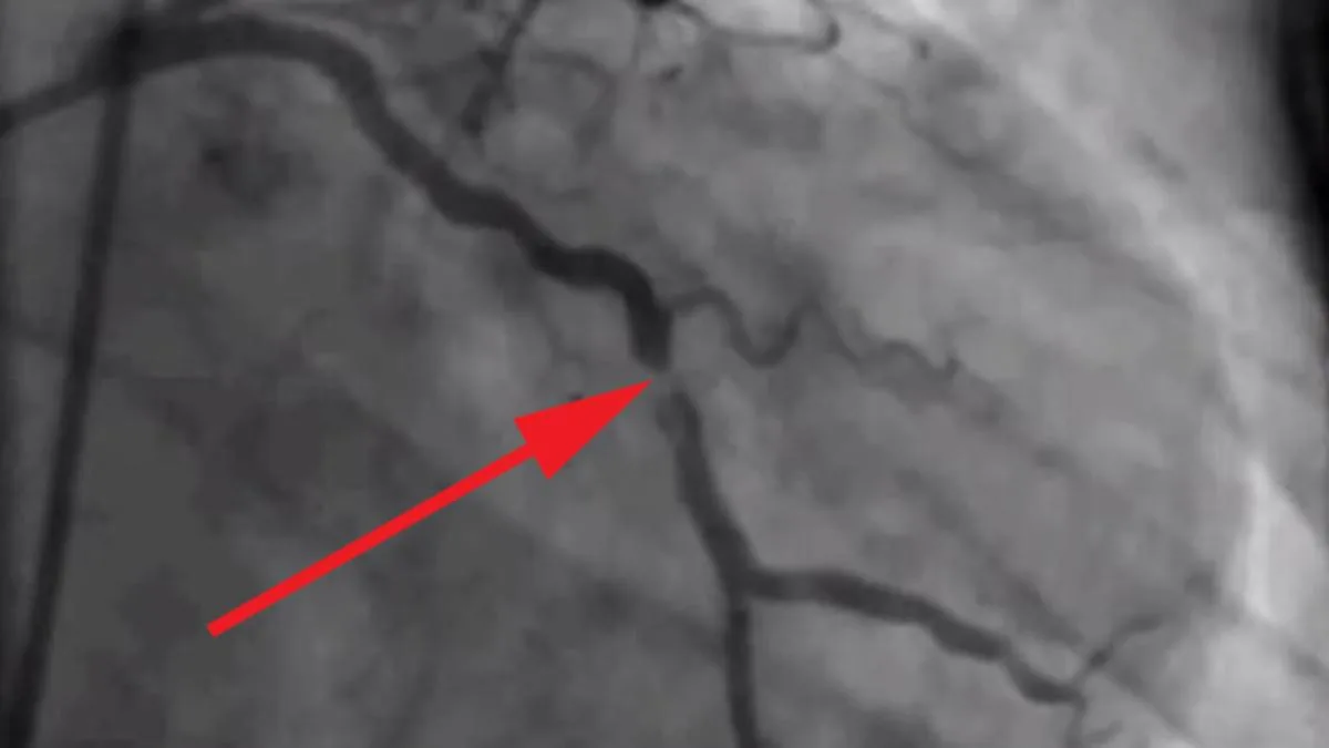 What is coronary thrombosis? Explained