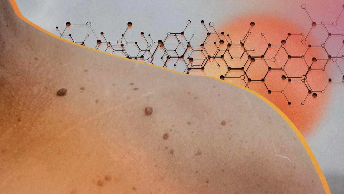 Cancer de la peau : le premier vaccin à base d’ARNm franchit une phase décisive