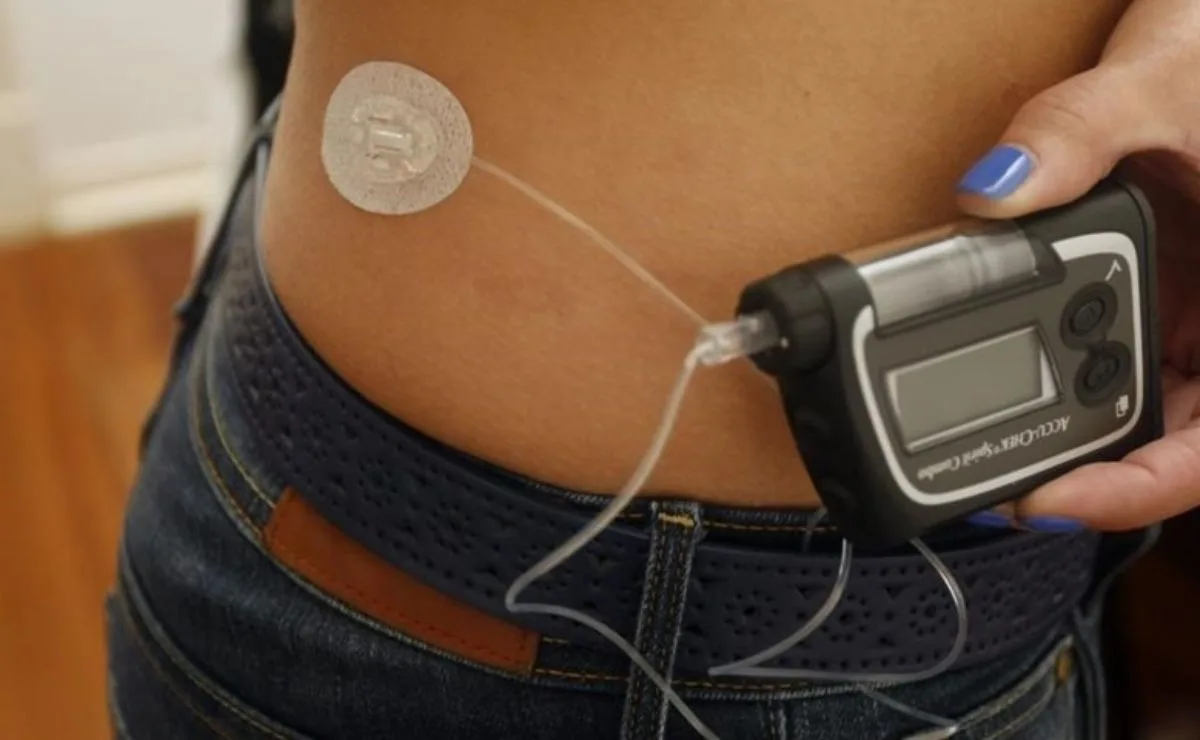 Bomba de insulina passa a ser coberta pelo plano de saúde para quem tem diabetes, propõe Projeto de Lei na Câmara dos Deputados