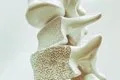 Pacientes de osteoporosis destacan la importancia de prevenir una segunda fractura para evitar más limitaciones