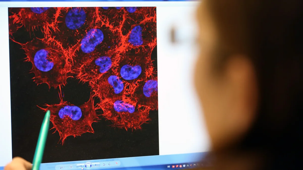 MSD und Moderna: Positive Testergebnisse für Hautkrebs-mRNA-Impfstoff