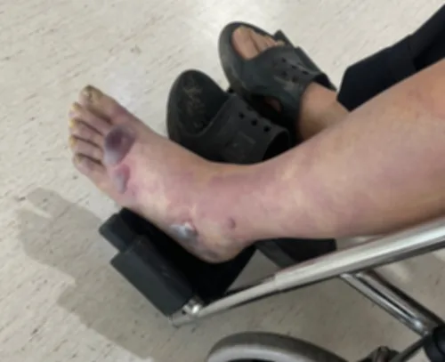 괴사로 악취·통증 호소한 70대 다리 절단…응급실 대응 논란