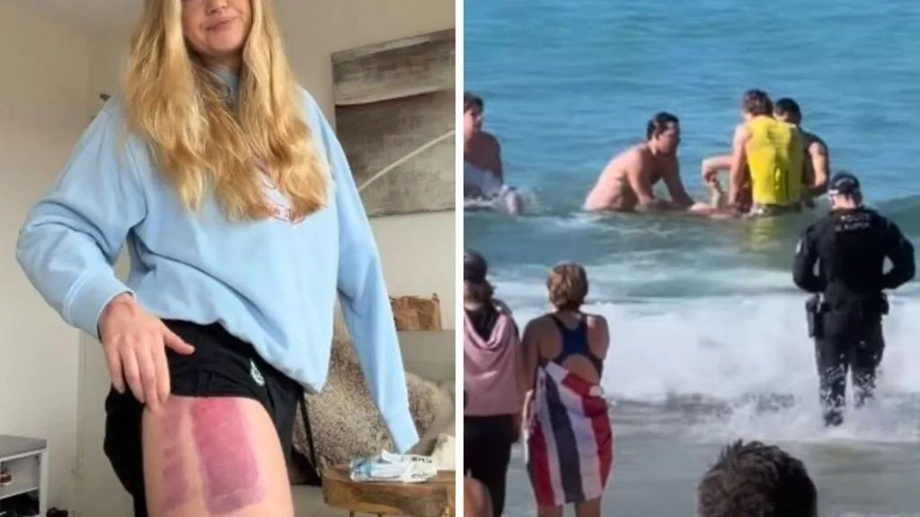 Coogee shark attack survivor Leah Stewart reveals skin graft has failed in heartbreaking recovery update