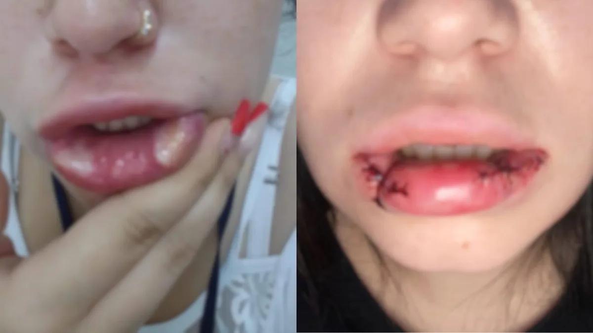 'Quase perdi a boca': mulher tem necrose após receber PMMA sem saber em SC; empresária é condenada