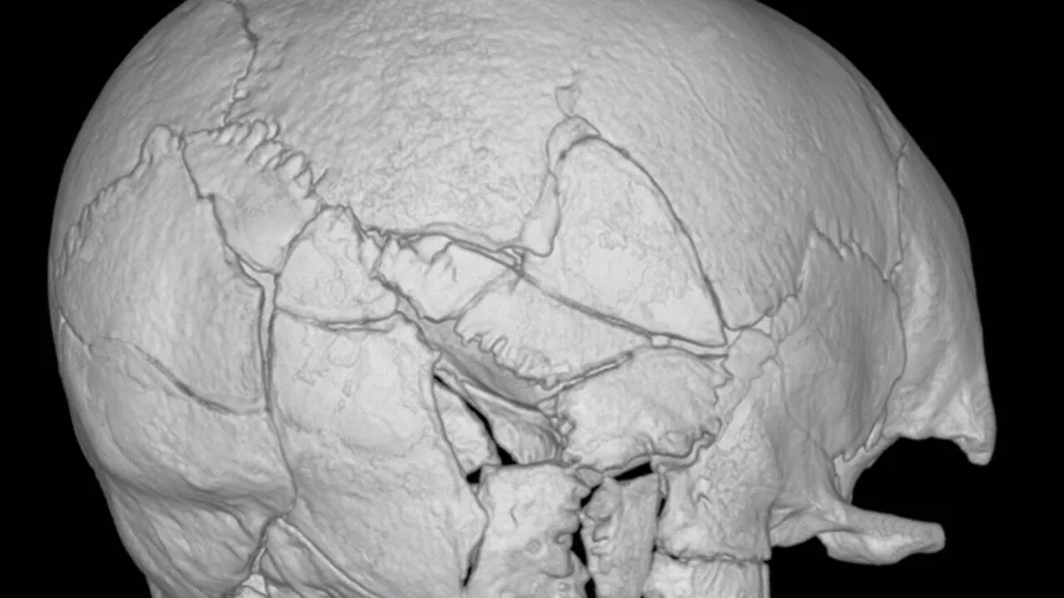 160 plus fractures found in Scottish castle skeleton may be first confirmed trebuchet death
