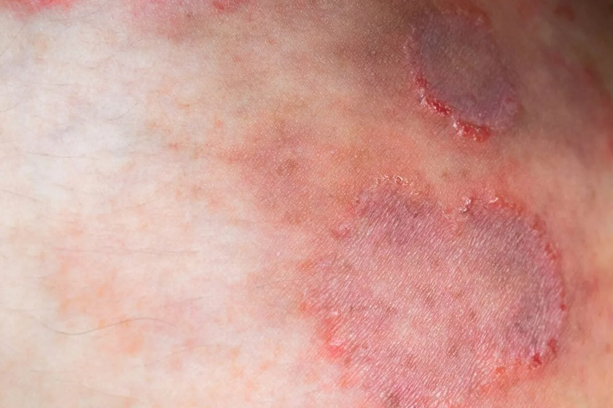 A Drug-Resistant Ringworm Fungus is Surging Across the Globe, Scientists Warn