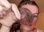 Mounjaro almost balded me...but thanks to a strict five-step hair routine it's finally growing back