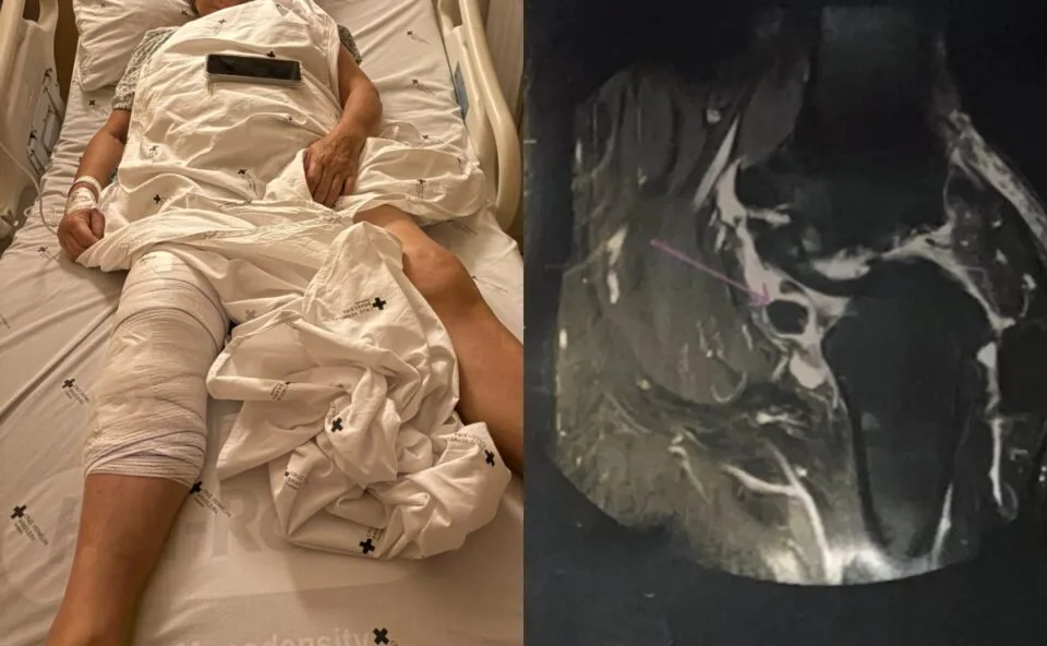 Hospital se pronuncia sobre cirurgia no joelho errado de idosa em Curitiba; CRM-PR investiga caso