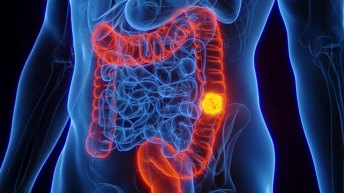Anvisa aprova novo tratamento para câncer de intestino