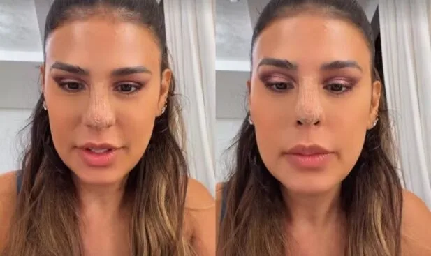 Simone Mendes admite susto com aparência após resultado inicial de procedimento no nariz; veja como ficou Simone Mendes admite susto com aparência após resultado inicial de procedimento no nariz; veja como ficou