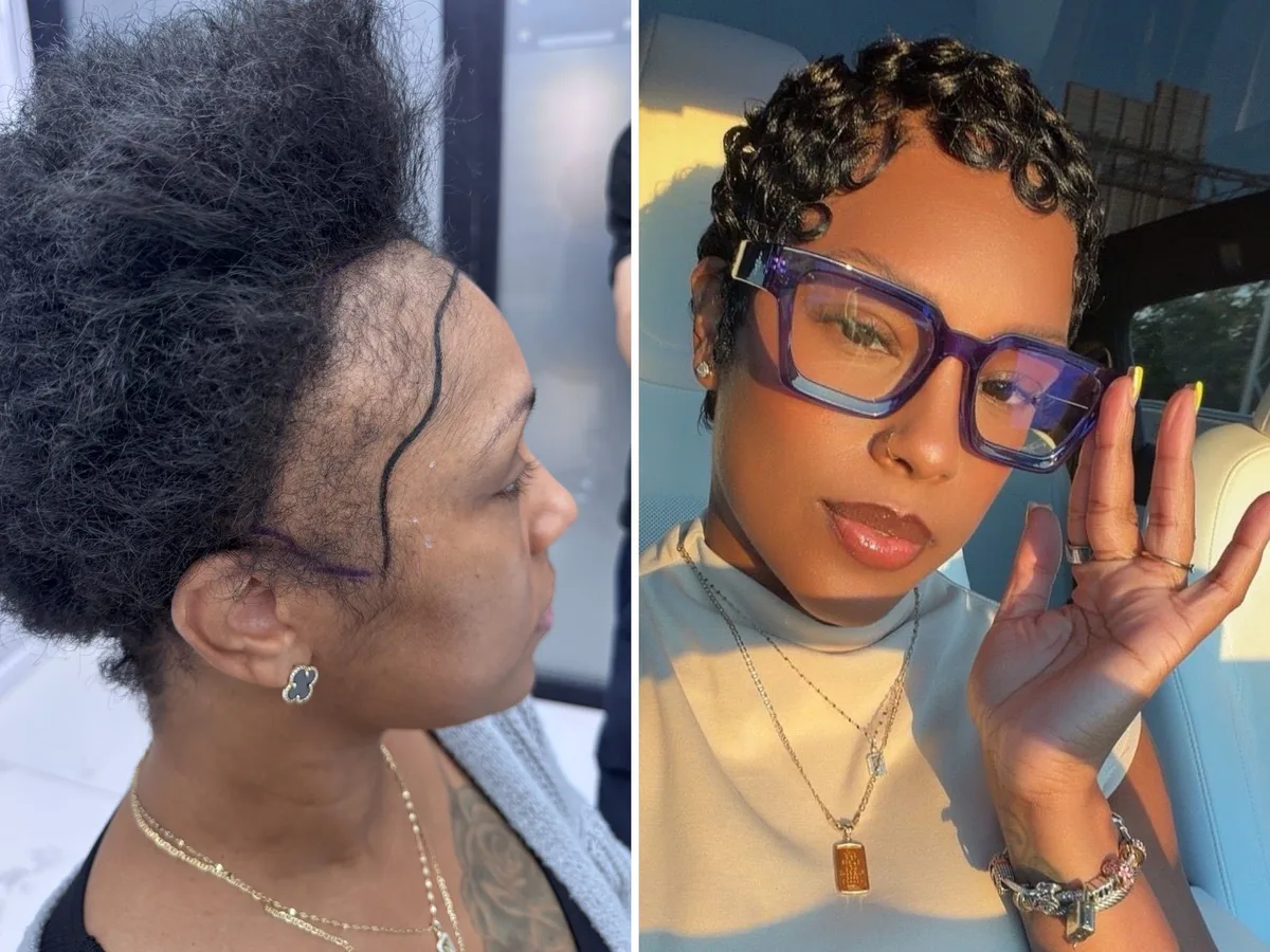 I couldn't afford a $13,000 hair transplant in the US. So I flew to Turkey and I love the results.