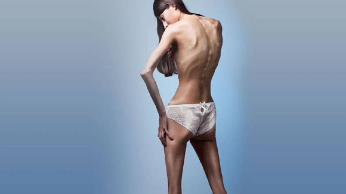 La anorexia también podría estar relacionada con la grasa: descubren una sorprendente pista genética