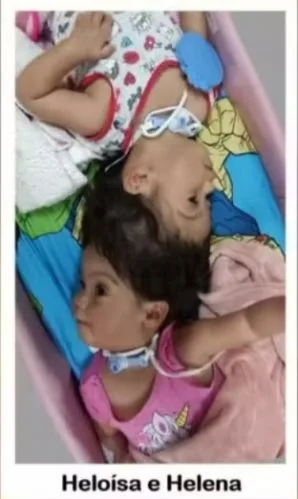 Gêmeas que nasceram unidas pela cabeça morrem em cirurgia final de separação no interior de SP Gêmeas que nasceram unidas pela cabeça morrem em cirurgia final de separação no interior de SP (Foto: Divulgação/Hospital das Clínicas de Ribeirão Preto)
