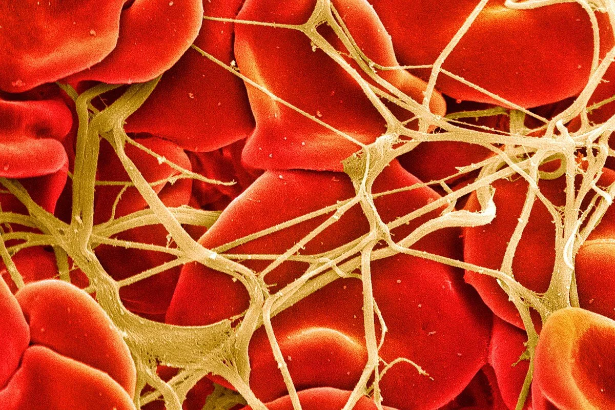 血友病の治療を一変させる新薬が続々 「1回で永久に効果」も視野