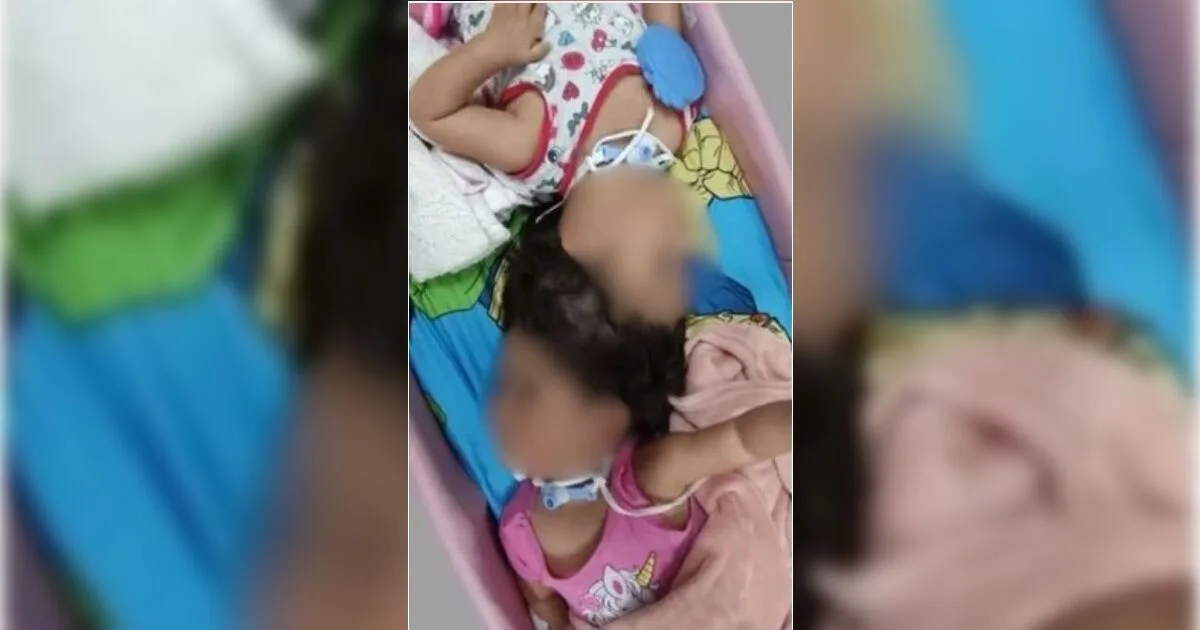 Gêmeas siamesas unidas pela cabeça morrem após cirurgia final de separação