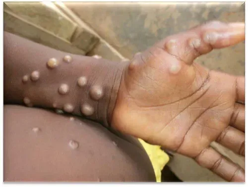 Mpox cases in South Africa rise to 22