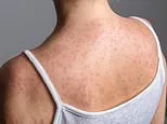 Sixth measles death recorded in America as outbreak spirals... as US records worst case count in 35 years