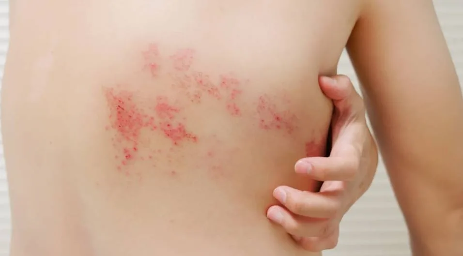 Brote de varicela en Neuquén: elevaron a 24 casos y activaron protocolos de prevención