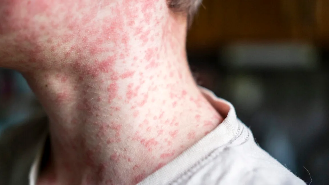 18-year-old dies of measles in PA from severe neurological complication