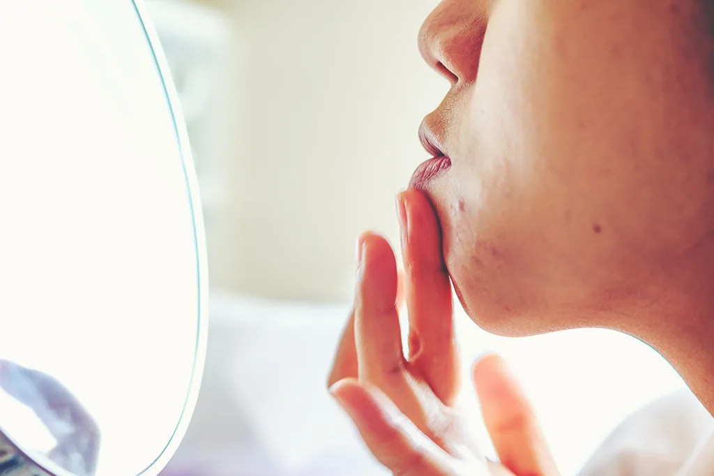 Dieta rica em alimentos antioxidantes ajuda a melhorar a acne, diz estudo