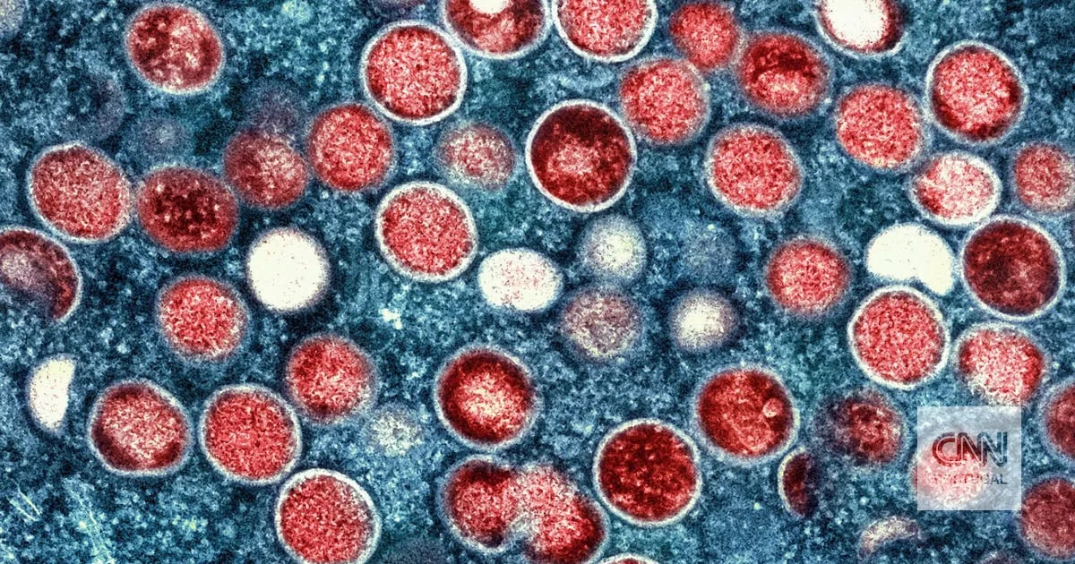 Mpox. Portugal regista transmissão comunitária e reporta 66 casos de infeção