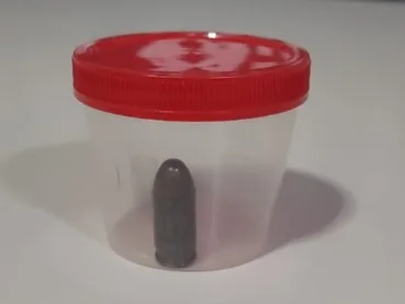 Munição intacta é retirada do intestino de homem durante cirurgia