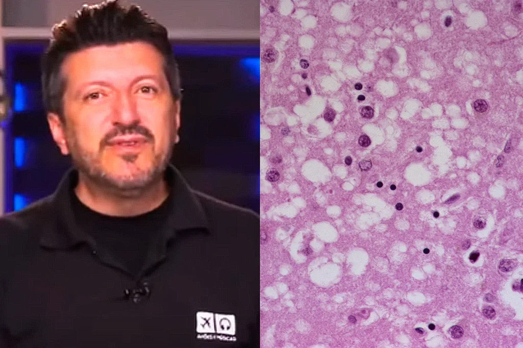 Creutzfeldt-Jakob: entenda a doença enfrentada por Lito Sousa, do canal Aviões e Músicas
