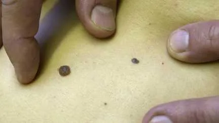 Le vaccin contre le cancer de la peau représente "un réel espoir," souligne l’oncologue Suzette Delaloge