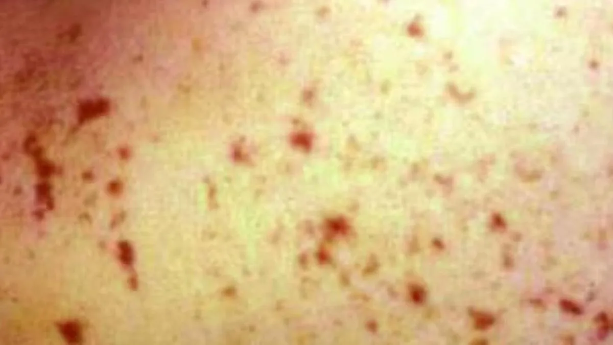 Urgent warning after second meningococcal alert reported in WA