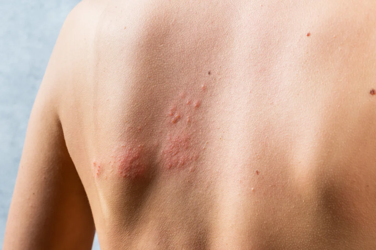 Herpes zóster: cuáles son los síntomas iniciales que la mayoría de los pacientes no reconoce