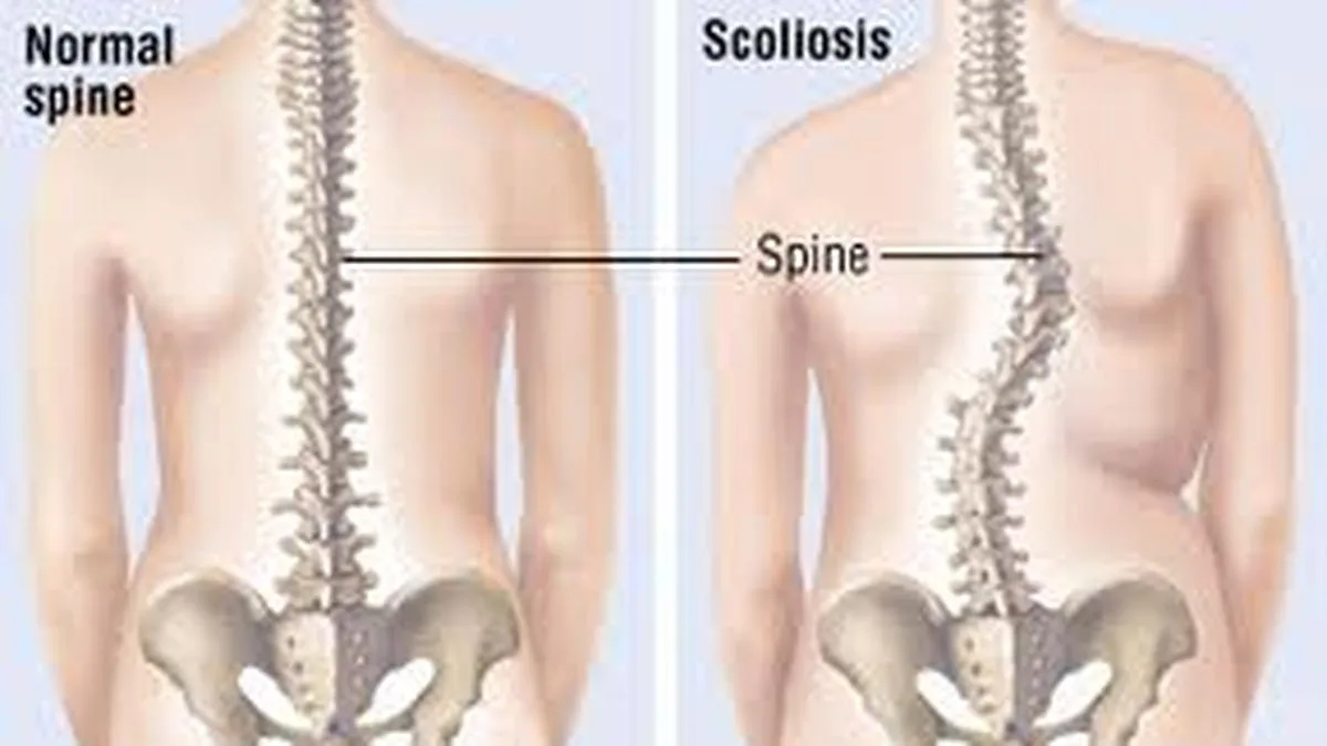 All you need to know about: scoliosis