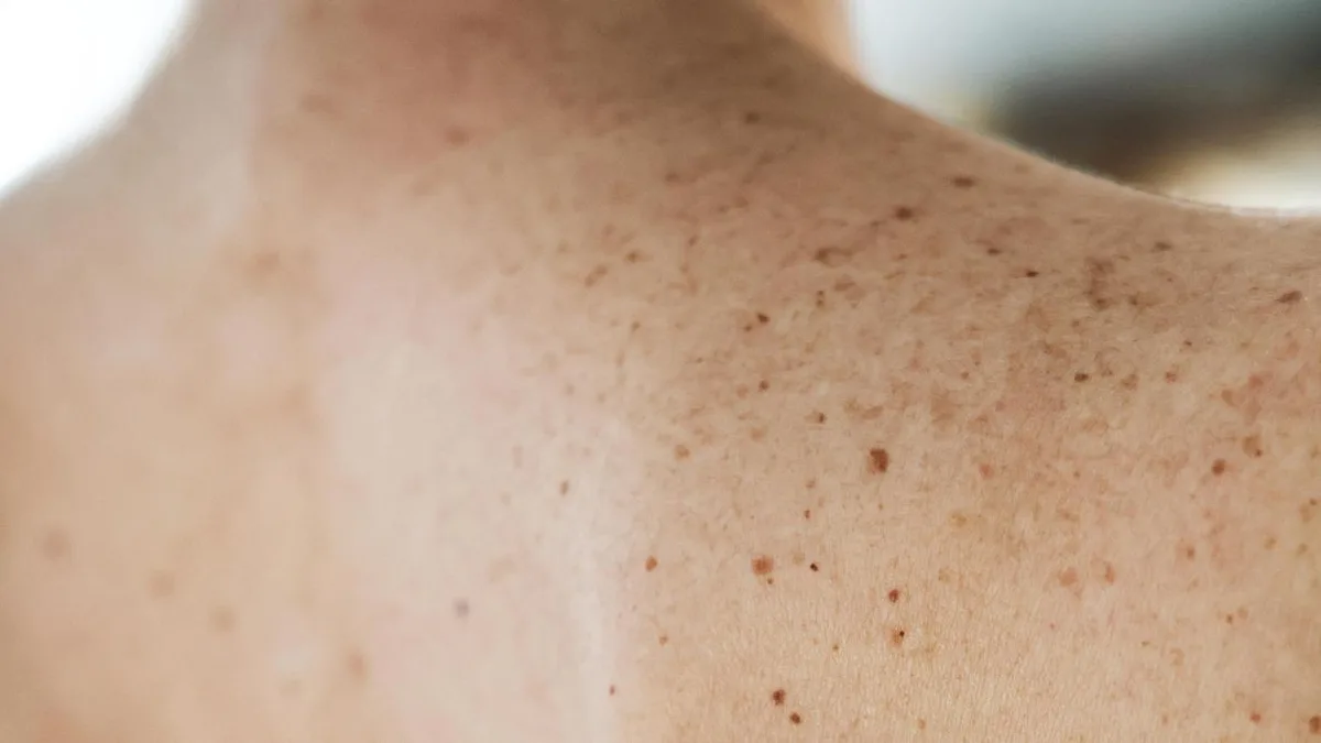Krebstherapie: Moderna meldet positive Ergebnisse in Studie zu Hautkrebs-Impfstoff