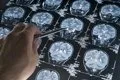 El nuevo mapa del cerebro revela 31 tipos de neuronas y una clave para entender enfermedades como el Huntington