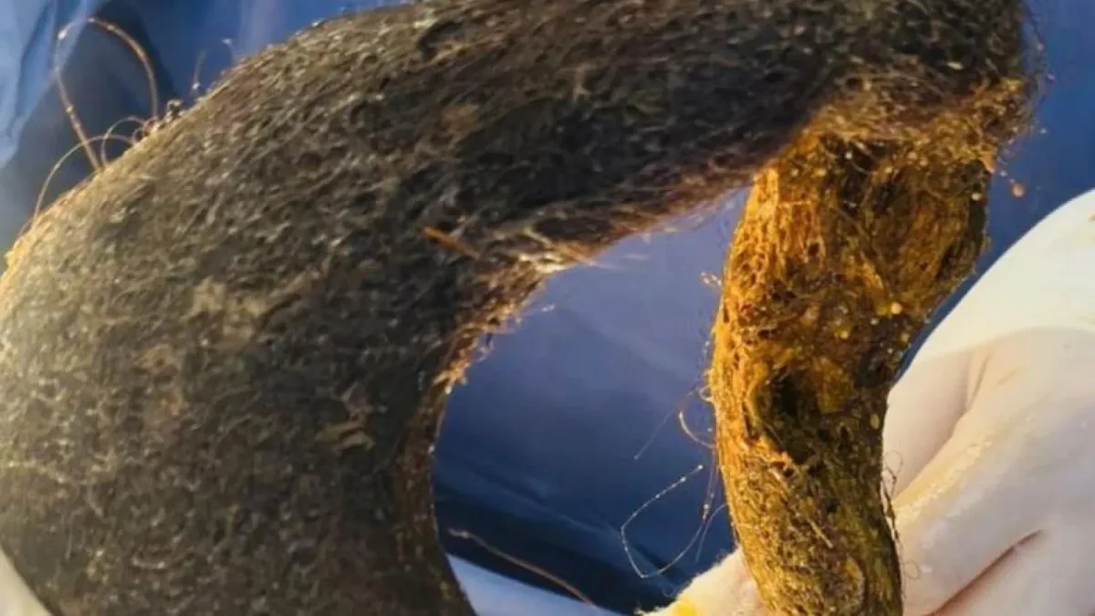Una gigantesca bola de pelo ocupa el 90% del estómago de una mujer: el extraño síndrome de Rapunzel