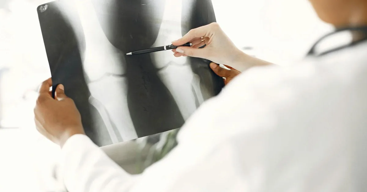 Un nuevo tratamiento para la artritis de rodilla proporciona un alivio duradero del dolor sin cirugía