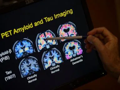 Want to lower your risk of dementia? It doesn't involve a blood test