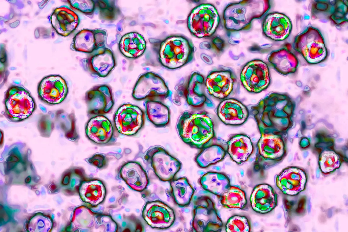 Pennsylvania teen dies from measles complications, health officials report