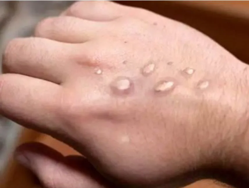 Cinco pacientes con mpox permanecen hospitalizados en Rusia