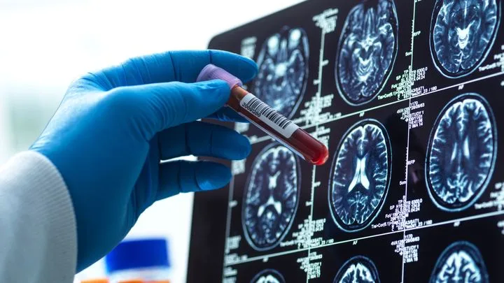 Alzheimer : comment faire face ? 2/4 : Les voies de la recherche