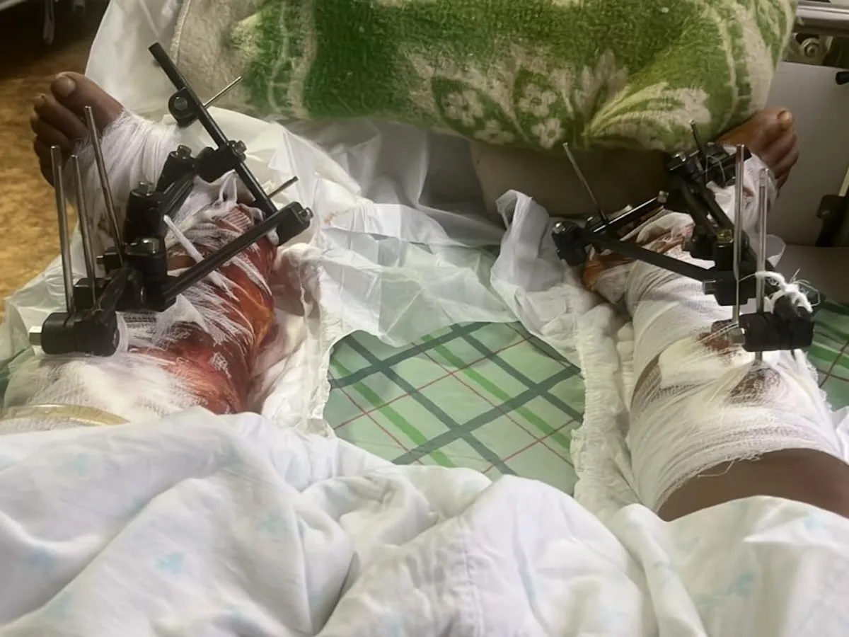 Lured to war: SA bodyguard returns from Russia, betrayed and with his leg amputated